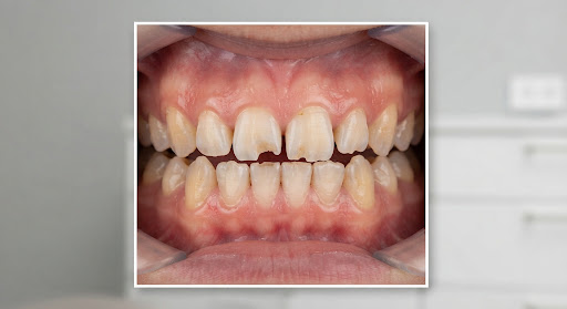 Short video: Invisalign check-in